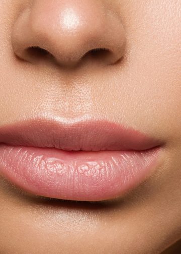 augmentare buze cu laser